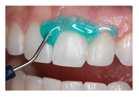 Fig. 1:  Aplique una barrera de 4-6mm de espesor de OpalDam/OpalDam Green  sobre la encía. Selle los espacios interproximales. Monte la resina aproximadamente 0,5mm  sobre el esmalte seco para sellar.