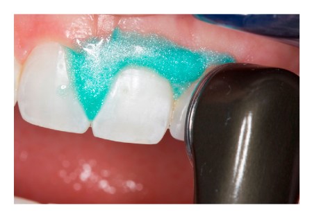 Fig. 3: Fotocure la resina 20 segundos por ancho de guía. Note las propiedades reflectivas de OpalDam/OpalDam Green.