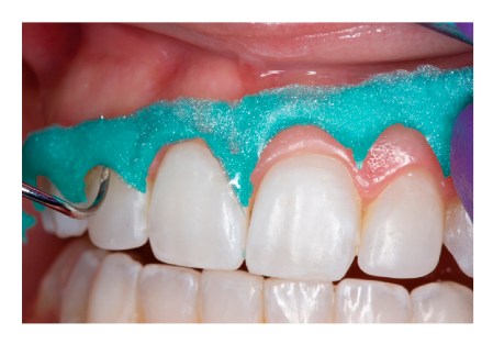 Fig. 4:  Después de fotocurada, OpalDam/OpalDam Green se remueve rápida y fácilmente en uno o varios trozos grandes. Controle interproximalmente que no haya resina retenida. OpalDam/OpalDam Green está diseñada para removerse fácilmente de zonas retentivas y espacios.