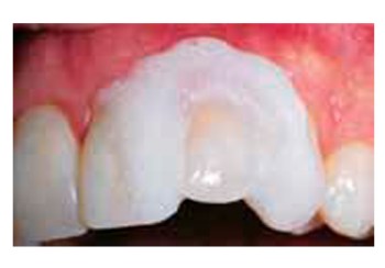 Fig. 5: Para blanqueamiento no vital, cubra aproximadamente la mitad de cada diente vital adyacente con una capa de 3-4mm de espesor de OpalDam/OpalDam Green para aislar dichos dientes de la incomodidad que produce el calor de la lámpara de fotocurado.