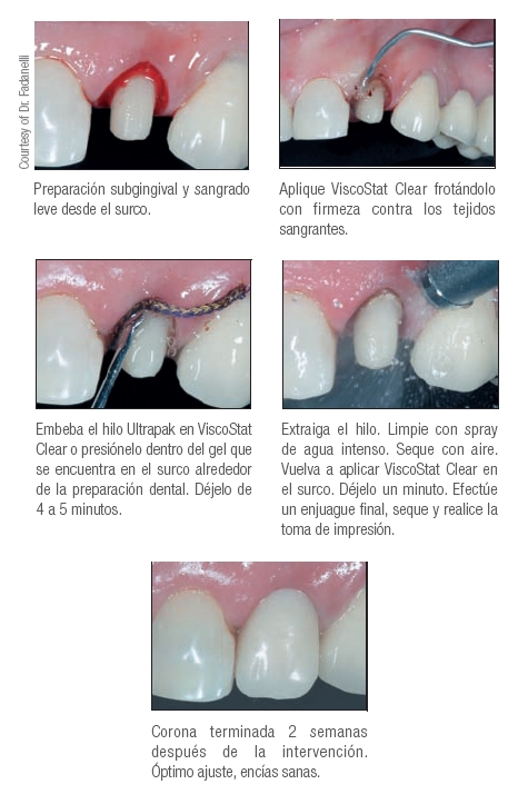 Uso de ViscoStat Clear