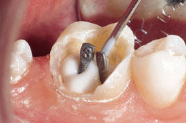 Permaflo DC en molar con pernos