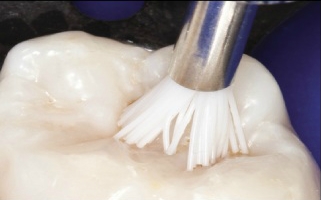 Higiene previa a colocación de sellantes