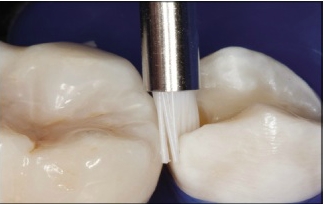 Limpieza de preparaciones