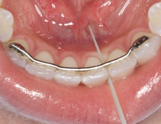 Uso Opalpix bajo retenedores adheridos