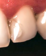 9   Resina Compuesta Clase III. Se ve el halo oscuro. 