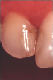 Otro caso en que se presenta el halo oscuro adyacente a la resina compuesta clase III.
