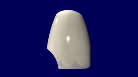 Fractura de un ángulo: Clase IV.