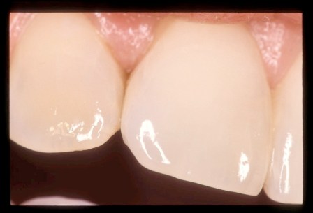 Compuesta Clase III. No se ve el halo oscuro.