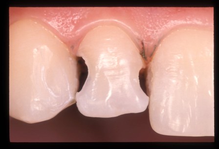 Cavidades Clase III.