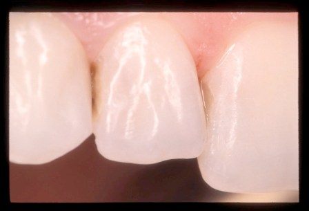 Resinas Compuestas en las Cavidades de Clase III. No se ve el halo oscuro. 