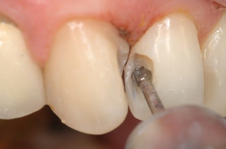 Figura 30: Eliminación de restauraciones filtradas y caries aparente.