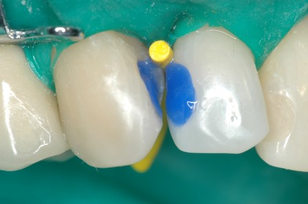 Figura 39: Grabado Ácido fosfórico al 35%.