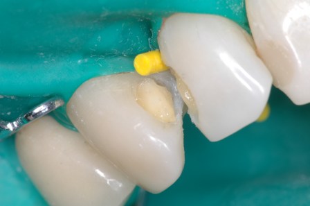 Figura 46: "Equilibrando la intensidad". Se usa A5-