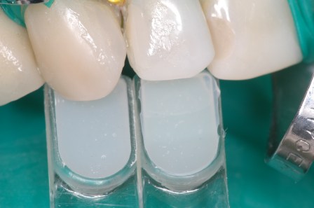 Figura 51: Corroboración del color de la Resina (la pieza dentaria está deshidratada).