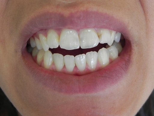 Foto 2 después de 4 jeringas de Opalescence