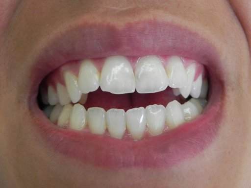 Foto 3 después de 8 jeringas de Opalescence