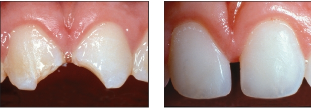 Opalescencia, Fluorescencia y Translucidez tan fabulosas que prácticamente permiten clonar los dientes. 
