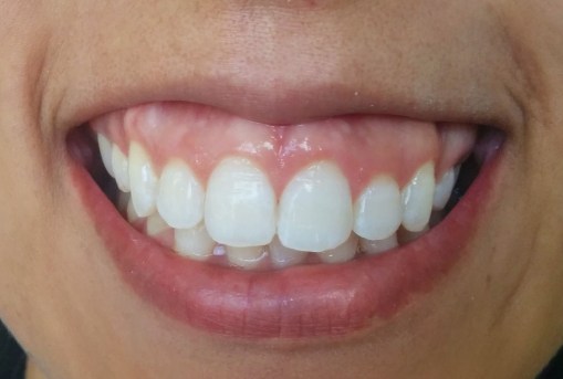 Imagen final. Luego de ligera abrasión con pasta Opalustre.