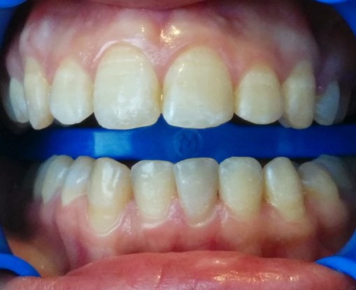 Imagen inicial. Se observan manchas blanquecinas y amarronadas, y textura rugosa del esmalte. 