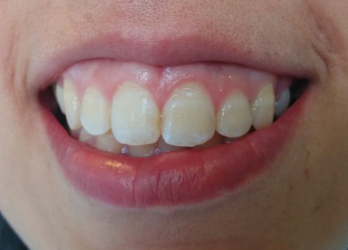 Imagen inicial. Sonrisa de la paciente