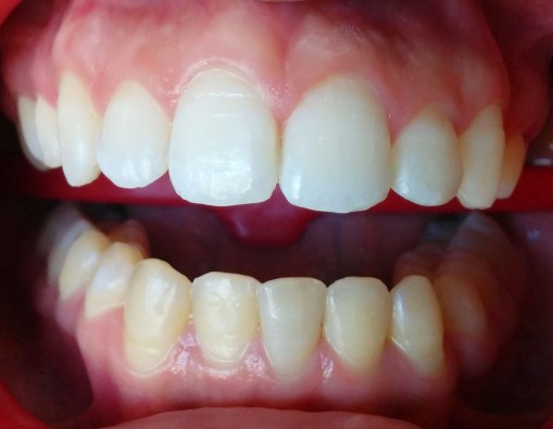 Blanqueamiento del maxilar superior.