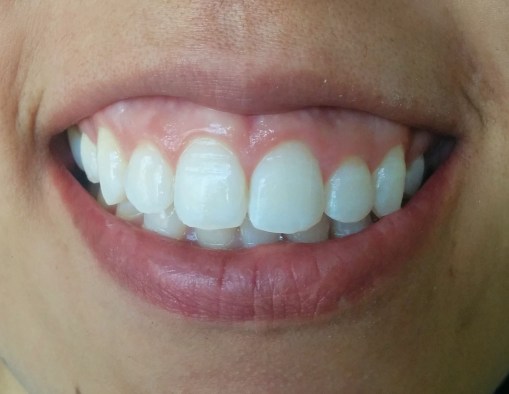 Textura rugosa del esmalte.