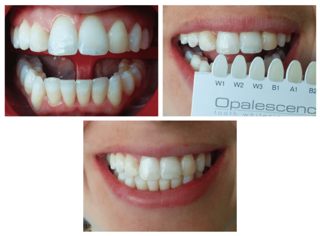 Control final del blanqueamiento. 