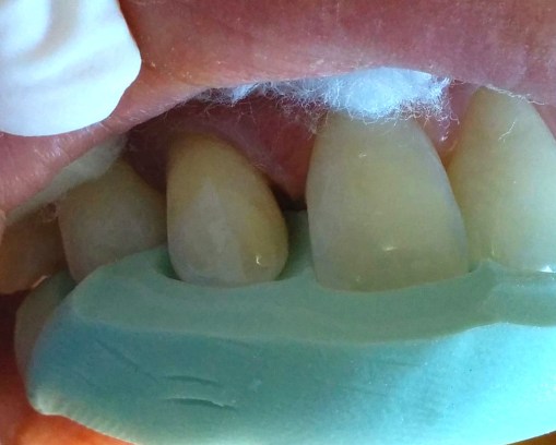 Posicionamiento de la llave de silicona para el cargado de la resina en palatino. 