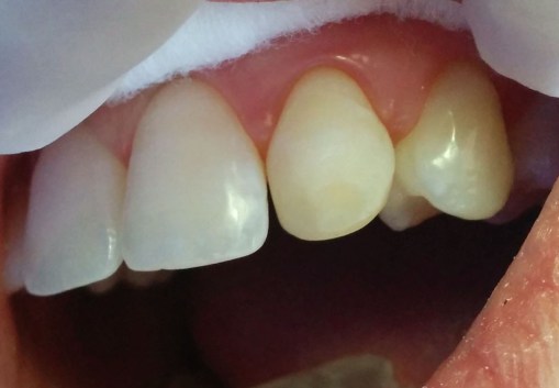 Luego de la remoción de la resina antigua. 