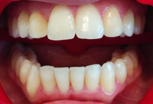 Imagen inicial. Se observa la diversidad de color, siendo los incisivos centrales más claros, y los laterales (con resina) más oscuros