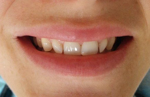 Imagen inicial. Sonrisa de la paciente.