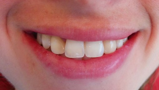 Imagen inicial. Sonrisa de la paciente. 