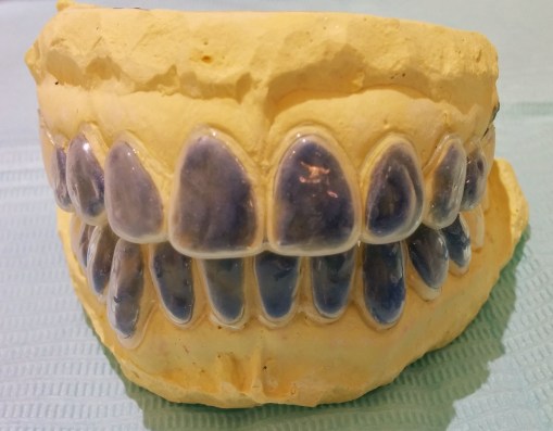 Modelos preparados con reservorios (resina LC Block-Out) y cubetas.