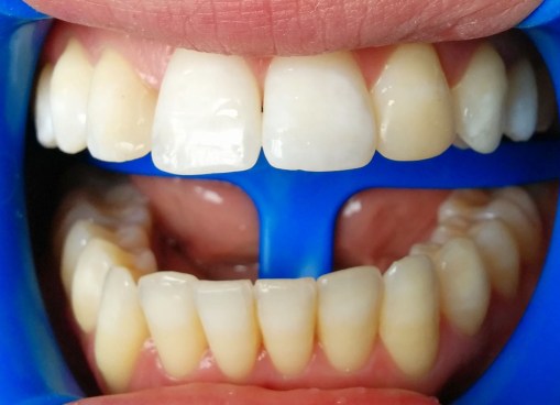 Blanqueamiento del maxilar superior en el segundo control. Se decide dejar de blanquear los incisivos centrales.