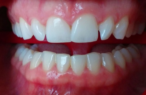 Control del blanqueamiento. Aún falta “iluminar” la sonrisa.