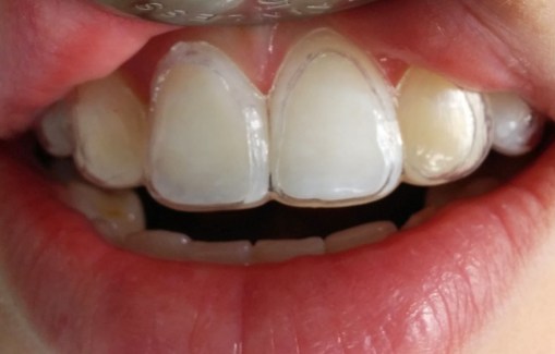 Recorte de la cubeta a modo de “ventana” en los incisivos centrales superiores.