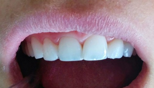 Luego del agregado de resina en forma directa, previo al pulido. 