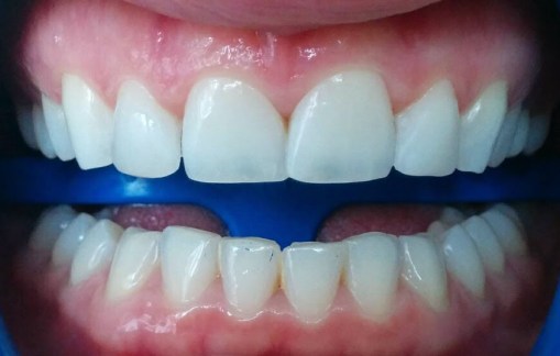 Imagen final. Luego de la terminación y pulido de las resinas.