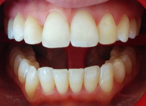 Blanqueamiento finalizado en el maxilar superior. Se comienza con el maxilar inferior.