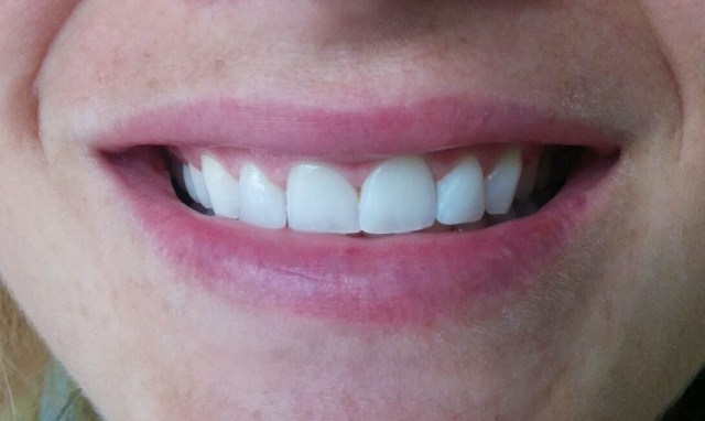 Imagen final. Sonrisa de la paciente.