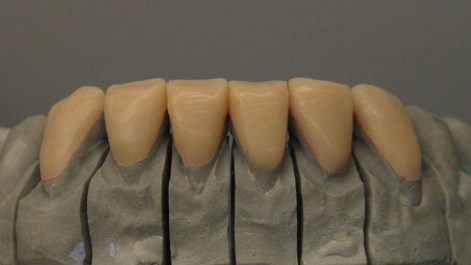 wax up para emax Mara Censato