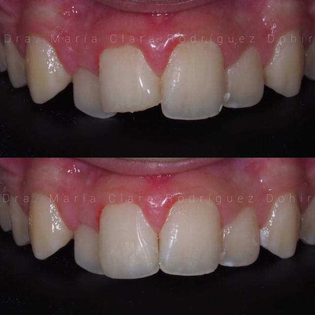 Reconstruccion de pieza 11 fracturada